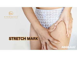 Stretch Mark Removal Treatment In Hyderabad - Eternelle Aesthetics