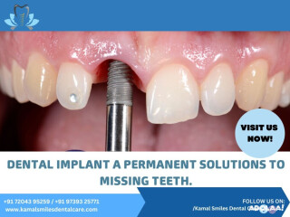 Exclusive Dental Implants in Bangalore with Kamal Smiles Dental Care