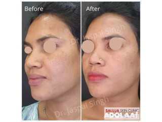 Skin treatment in Bilaspur | Saluja skin clinic