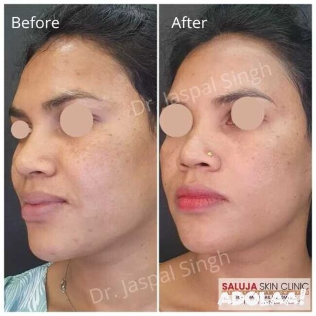 skin-treatment-in-bilaspur-saluja-skin-clinic-big-0