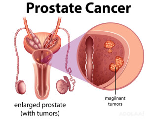 Prostate cancer treatment in india