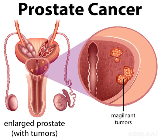 prostate-cancer-treatment-in-india-big-0