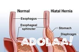 inguinal-hernia-treatment-in-mumbai-big-0
