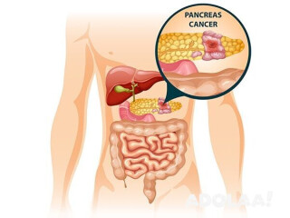 Pancreatic Cancer Treatment In India