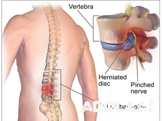 Spine Surgery Cost In India