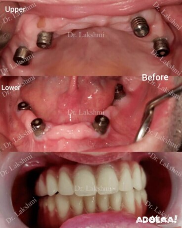 best-dental-implants-in-bangalore-dental-implants-cost-in-goa-big-0