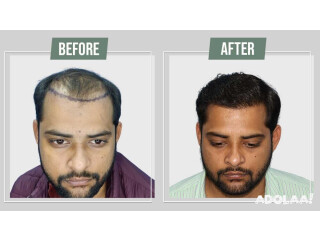 Hair transplant in Jodhpur