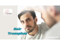 hair-transplant-in-gurgaon-sb-trichology-small-0