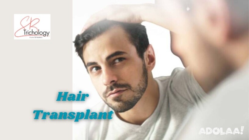 hair-transplant-in-gurgaon-sb-trichology-big-0