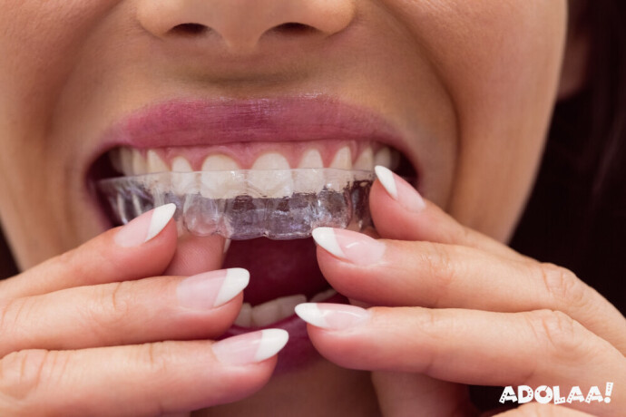 invisible-teeth-braces-cost-in-india-big-0
