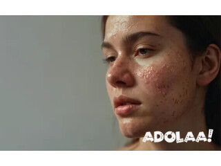 Acne treatment in Delhi