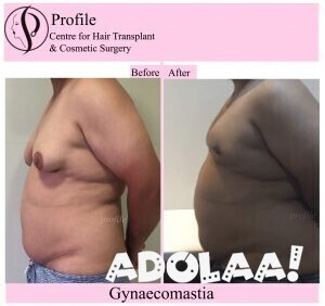 gynecomastia-surgery-in-ludhiana-big-0