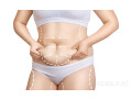 how-to-avoid-complications-for-liposuction-surgery-small-0