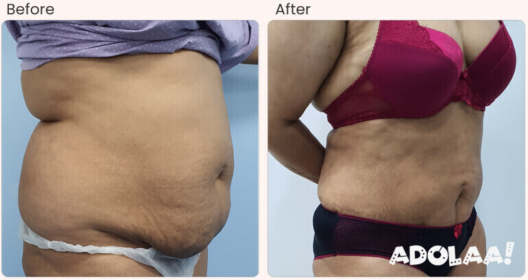 what-to-expect-before-and-after-the-liposuction-procedure-big-0