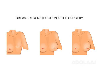Restoring Confidence: The Impact of Breast Reconstruction on Self-Esteem