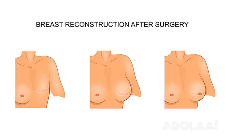 restoring-confidence-the-impact-of-breast-reconstruction-on-self-esteem-big-0
