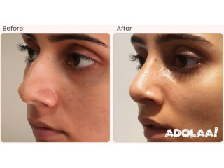 Rhinoplasty Surgery in Delhi - Dr Rajat Gupta