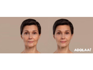 What to Expect When Getting a Facelift?