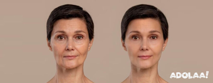 what-to-expect-when-getting-a-facelift-big-0