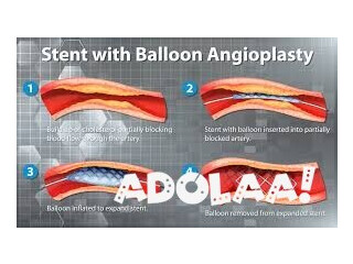 Angioplasty in Mumbai