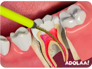Affordable Root Canal Specialist Near You in Juhu The Smile Spa