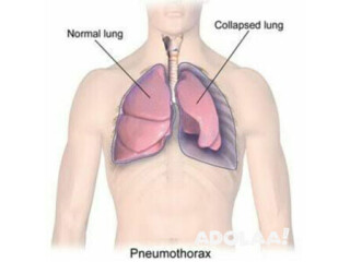 GET THE BEST PNEUMOTHORAX TREATMENT IN DELHI AT DR. HARSHVARDHAN PURI'S CLINIC