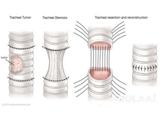 TRACHEAL STENOSIS TREATMENT IN DELHI AND GURGAON, INDIA