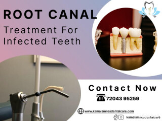 Say Goodbye to Tooth Pain: Experience Expert Root Canal Treatment!