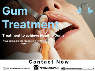 Best Gum Surgeries in Bangalore! Experience Excellence at Kamal Smiles Dental Care