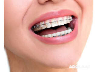 Braces Treatment in Near Me | Dental Braces Treatment Near Me