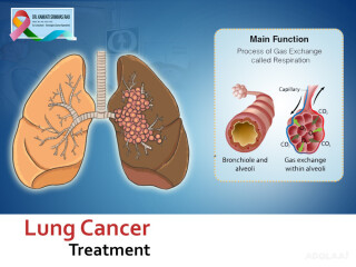 Best Lung Cancer Treatment In Hyderabad-Drksrinivascancercare