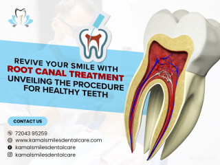 Restore Your Smile: Expert Root Canal at Kamal Smiles!