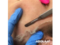 microdermabrasion-saskatoon-small-0