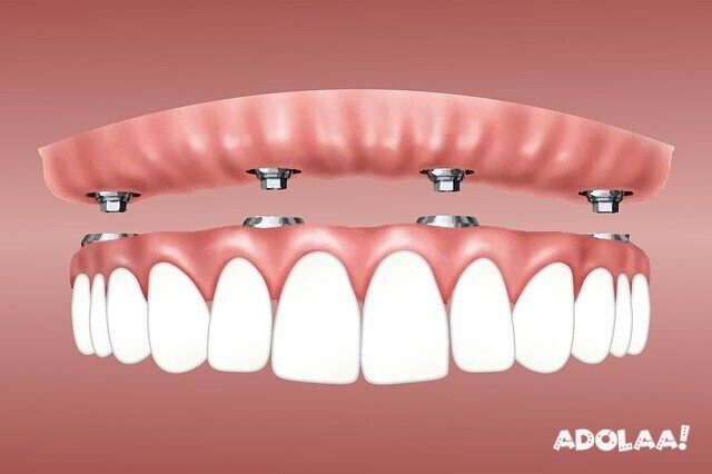 different-types-of-dental-implants-you-can-undergo-in-southeast-london-big-0