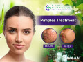 clear-skin-naturally-pimple-solutions-at-anand-homeopathy-clinic-small-0