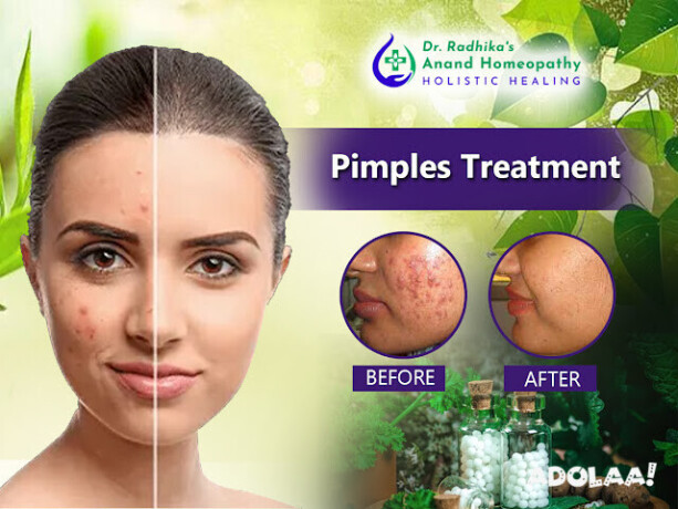 clear-skin-naturally-pimple-solutions-at-anand-homeopathy-clinic-big-0