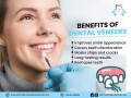 transform-your-smile-with-dental-veneers-at-kamal-smiles-dental-care-small-0