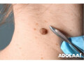 best-mole-removal-in-glenfield-small-0