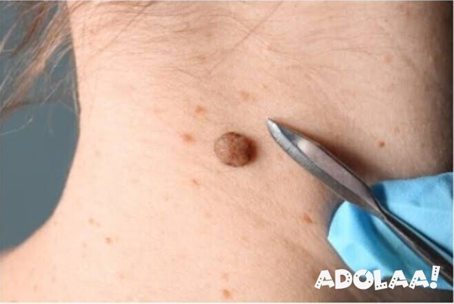 best-mole-removal-in-glenfield-big-0