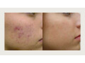 dermaplaning-treatment-asheville-small-0