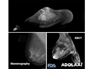 Koning Vera Breast CT For Painless Mammograms