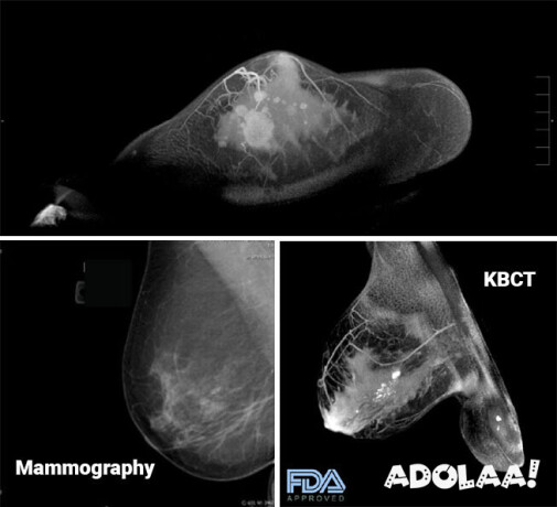 koning-vera-breast-ct-for-painless-mammograms-big-0