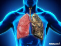 lung-cancer-symptoms-causes-and-treatment-small-0