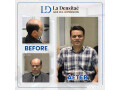 hair-patch-in-pune-restoring-confidence-with-la-densitae-hair-wig-small-1