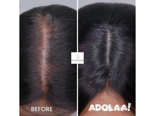 Hair Replacement System for Women