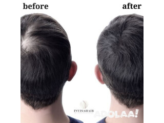 Best Hair Replacement System in Yorba Linda